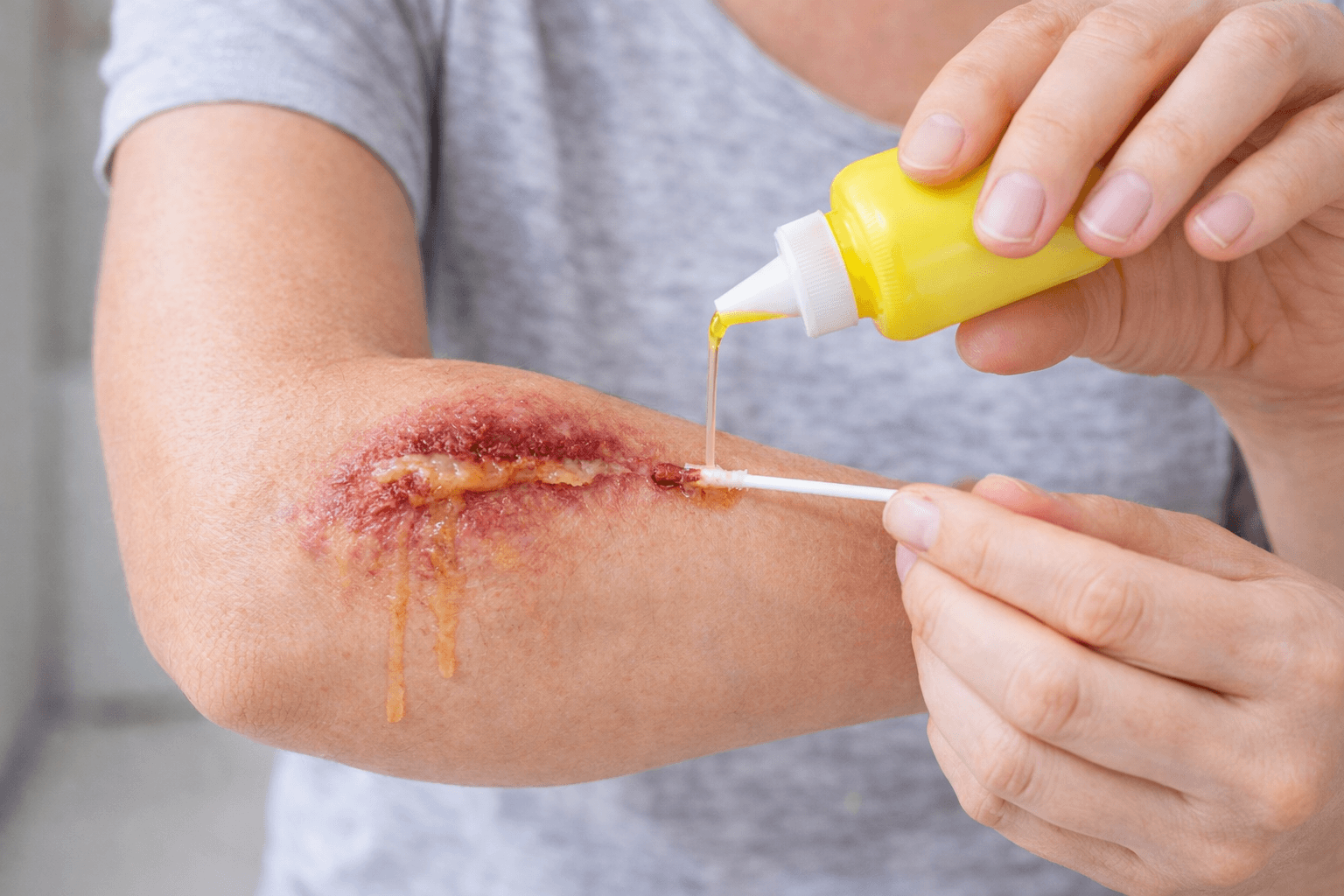 Ako rozpoznať infekciu v rane (kedy ísť k lekárovi)