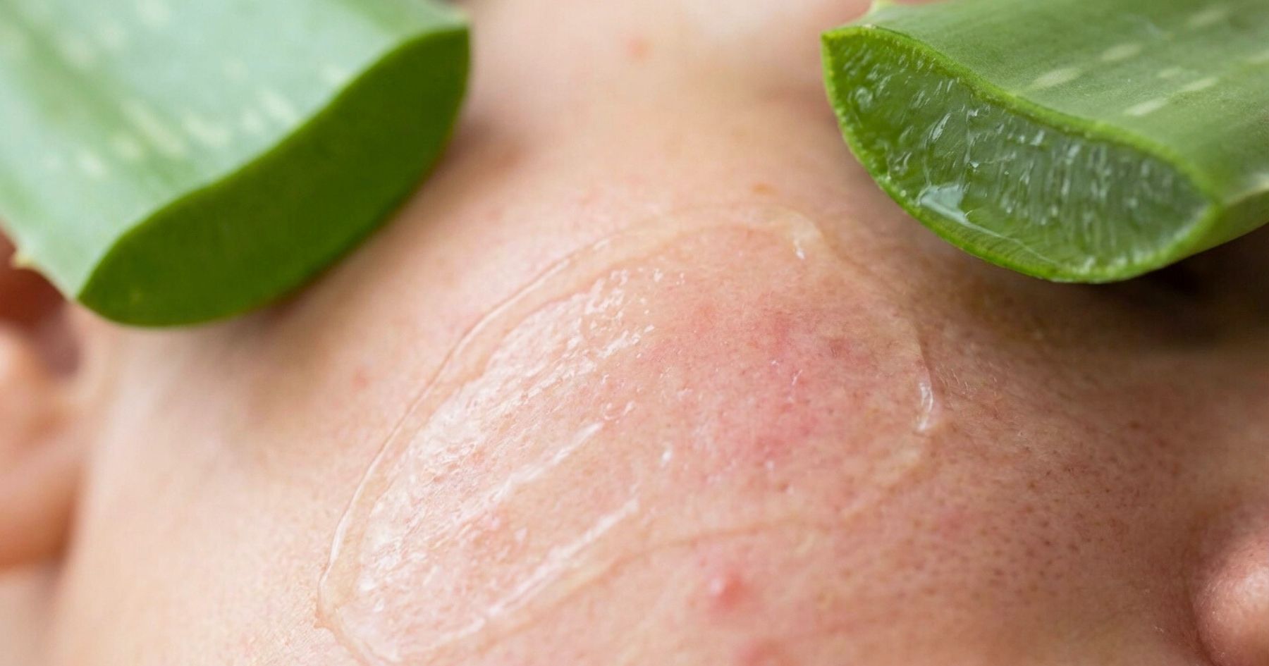 Aloe vera a jizvy po akné