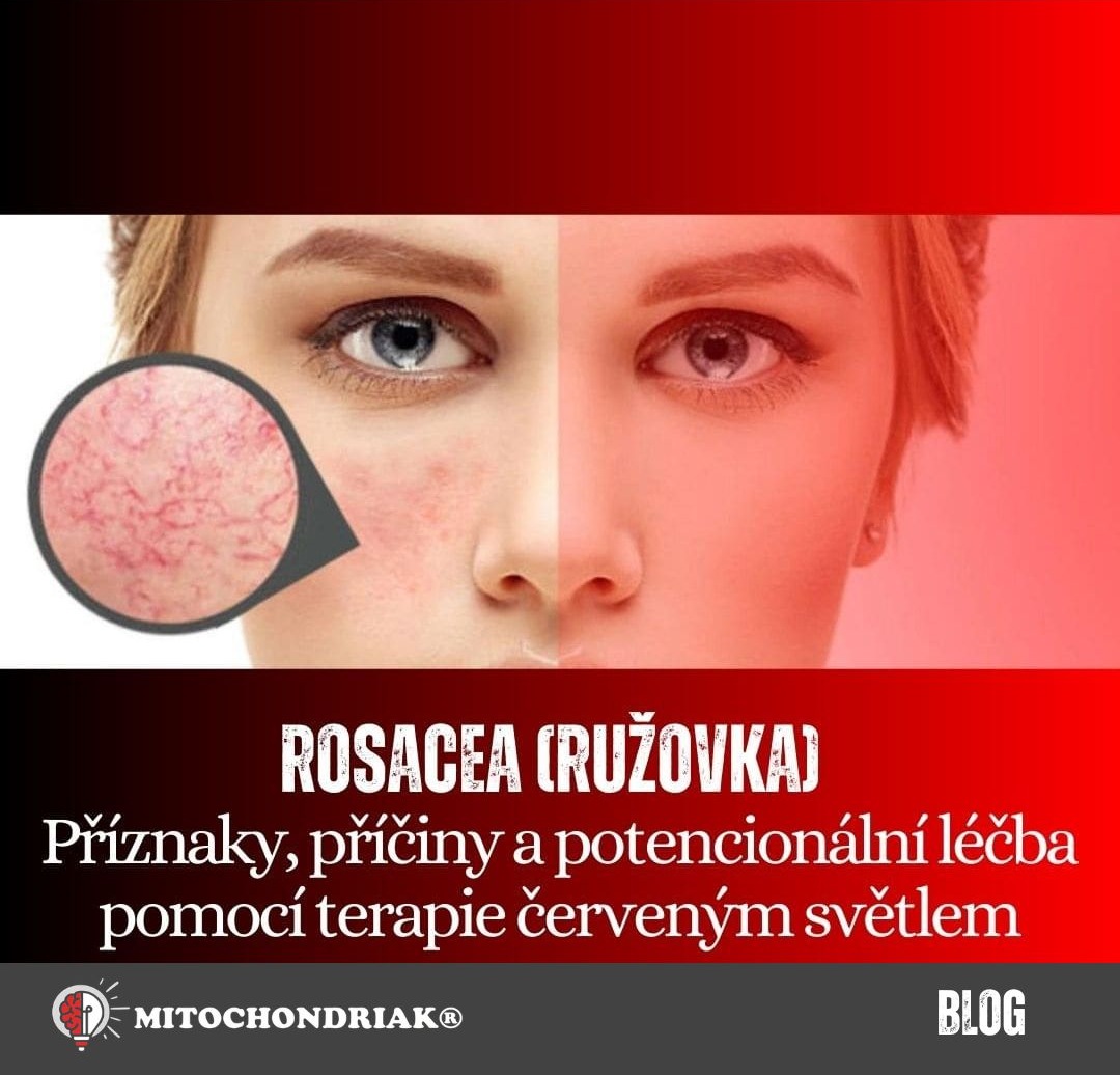 Rosacea (ružovka) Príznaky, príčiny a terapia červeným a infračerveným svetlom (2) (1)