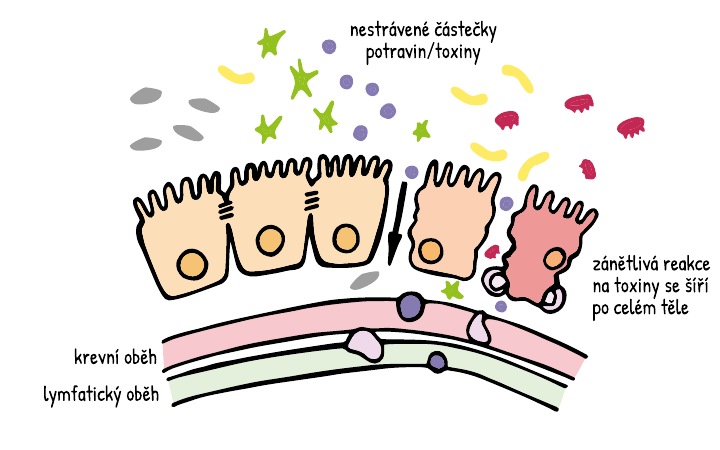 Leaky gut syndrom (propustnost střev) a zánětlivé onemocnění střev