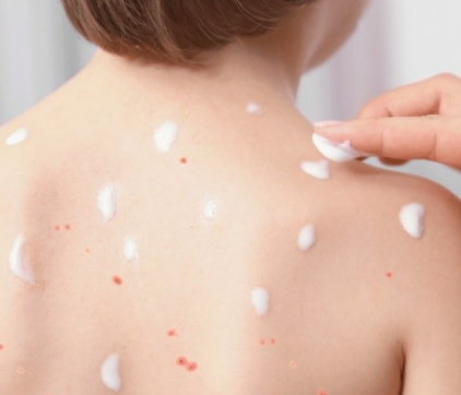 Neštovice u dětí: Příznaky a jak s nemocí bojovat