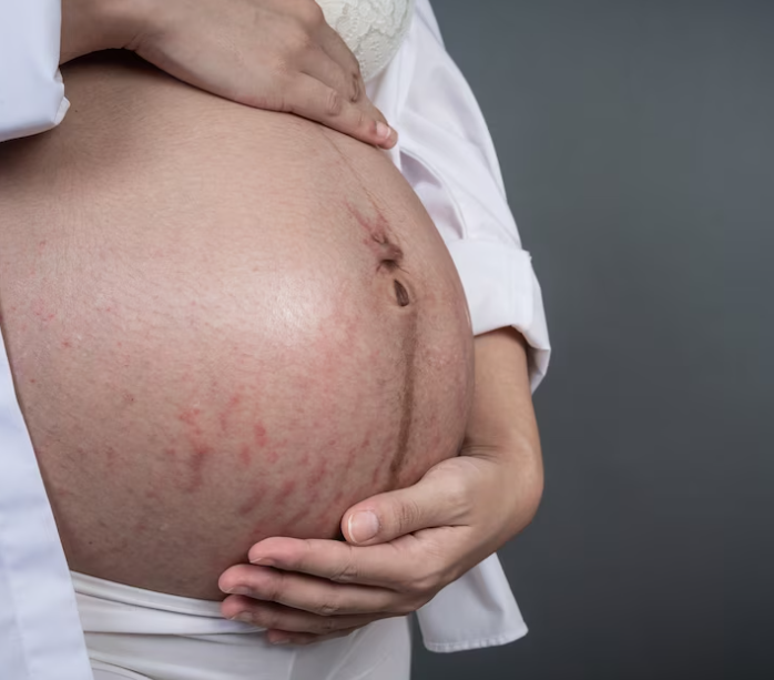 Jak předejít striím v těhotenství