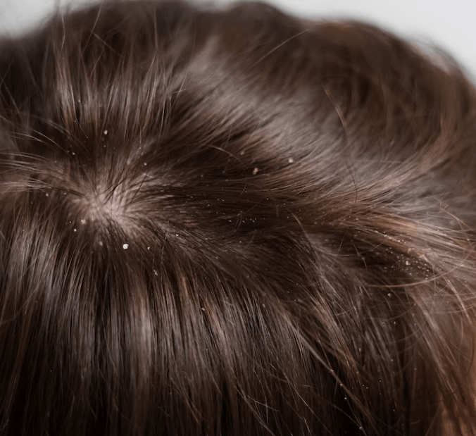 Lupy ve vlasech: Jak se jich účinně zbavit a proč se tvoří