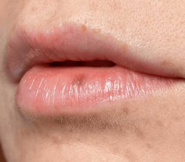 Jak efektivně vyléčit afty u dětí