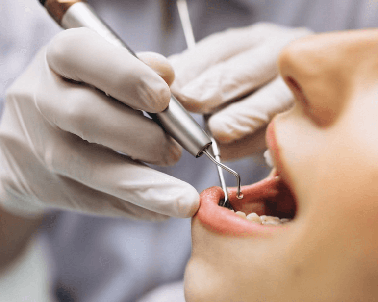 Jak účinně odstranit zubní plak ze zubů