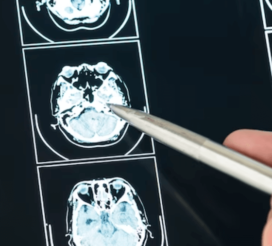 Co je hypodenzita: Vysvětlení a význam