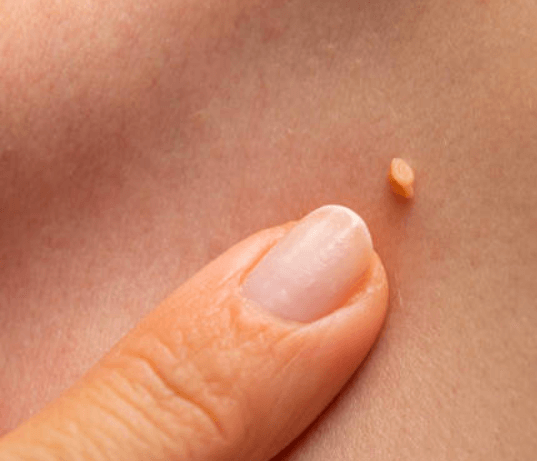 Co je papilom: Malé výrůstky na kůži a sliznicích