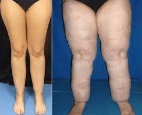 Co je lipedém: Diagnóza, příznaky a možnosti léčby