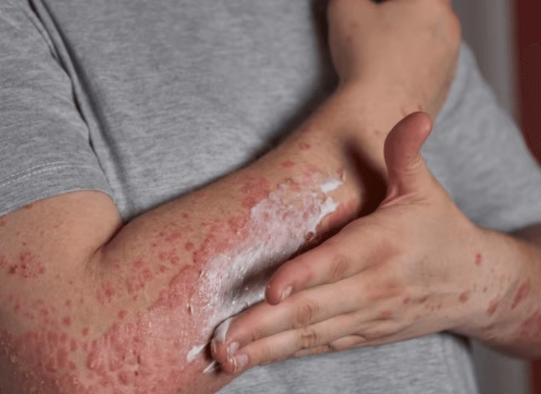 Opičí neštovice: Nemoc způsobená virem varicella-zoster