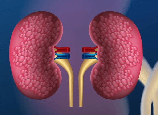 Jak pročistit ledviny: rady a metody pro zdravější ledviny