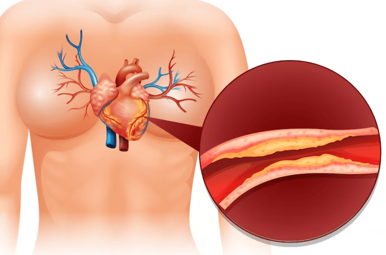 Co je hyperlipidémie: Příznaky, diagnostika a léčba