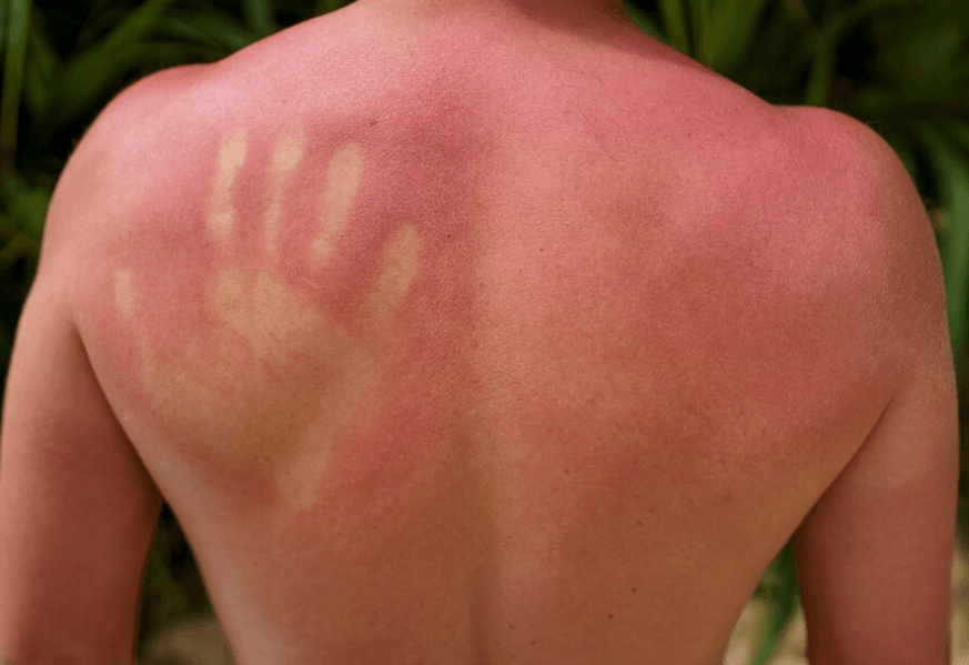 Jak ošetřit popáleniny: První pomoc a rady pro rychlou léčbu