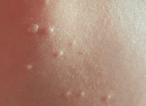 Jak vypadá molluska: Charakteristika této virové infekce