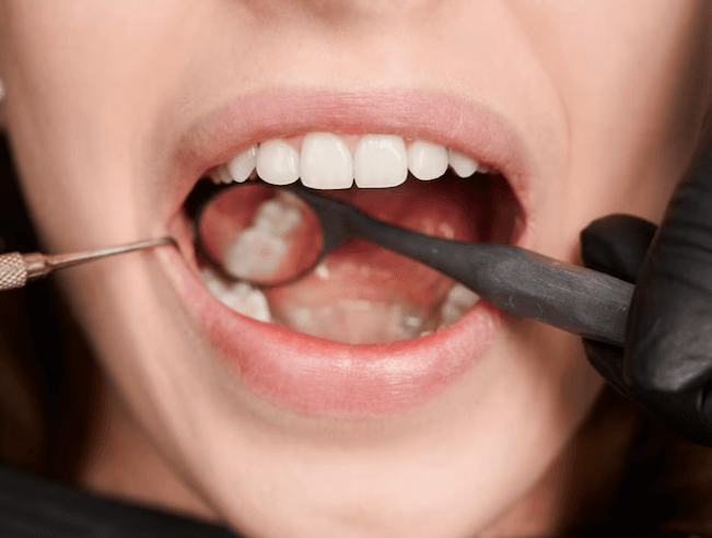 Jak na zubní kámen: Prevence a léčba pro zdravý úsměv