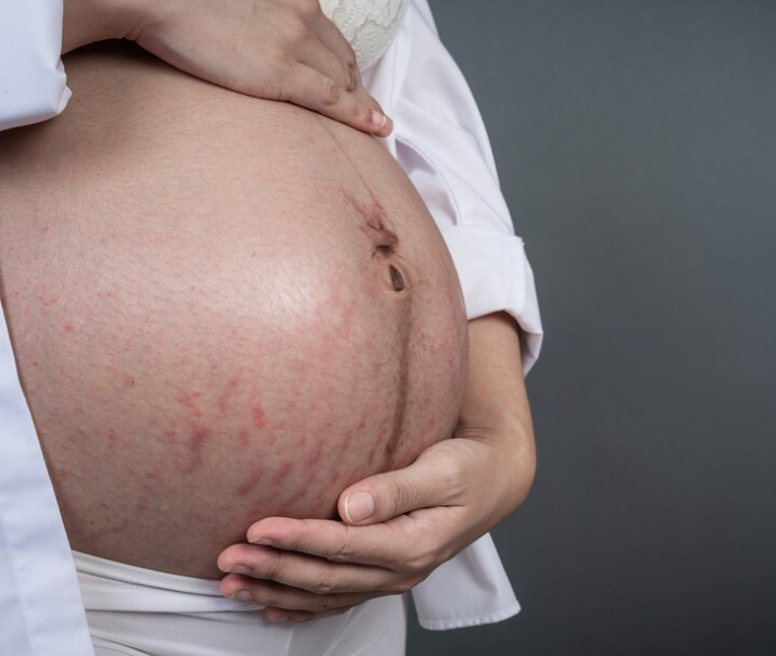 Strie v těhotenství a po porodu – Odborné rady pro péči a zmírnění