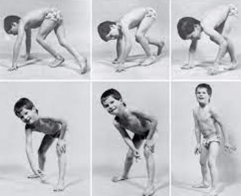 Co je Beckerova muskulární dystrofie a jak se léčí