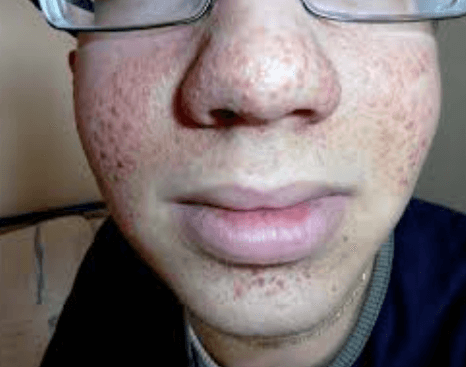 Co je Tuberózní skleróza a jak se léčí