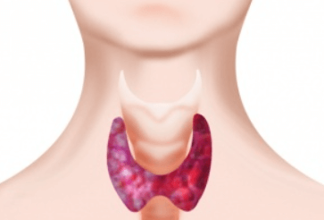 Co je Hypothyreóza a jak se léčí