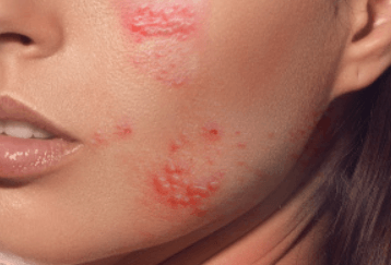 Co je Adrenogenitální syndrom a jak se léčí