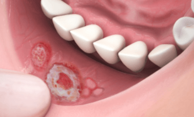 Co je Hirschsprungova nemoc a jak se léčí