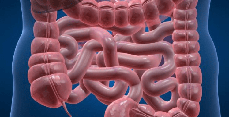 Co je Meckelův divertikl a jak se léčí