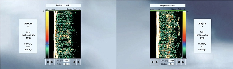 Výsledek ultrazvuku kůže