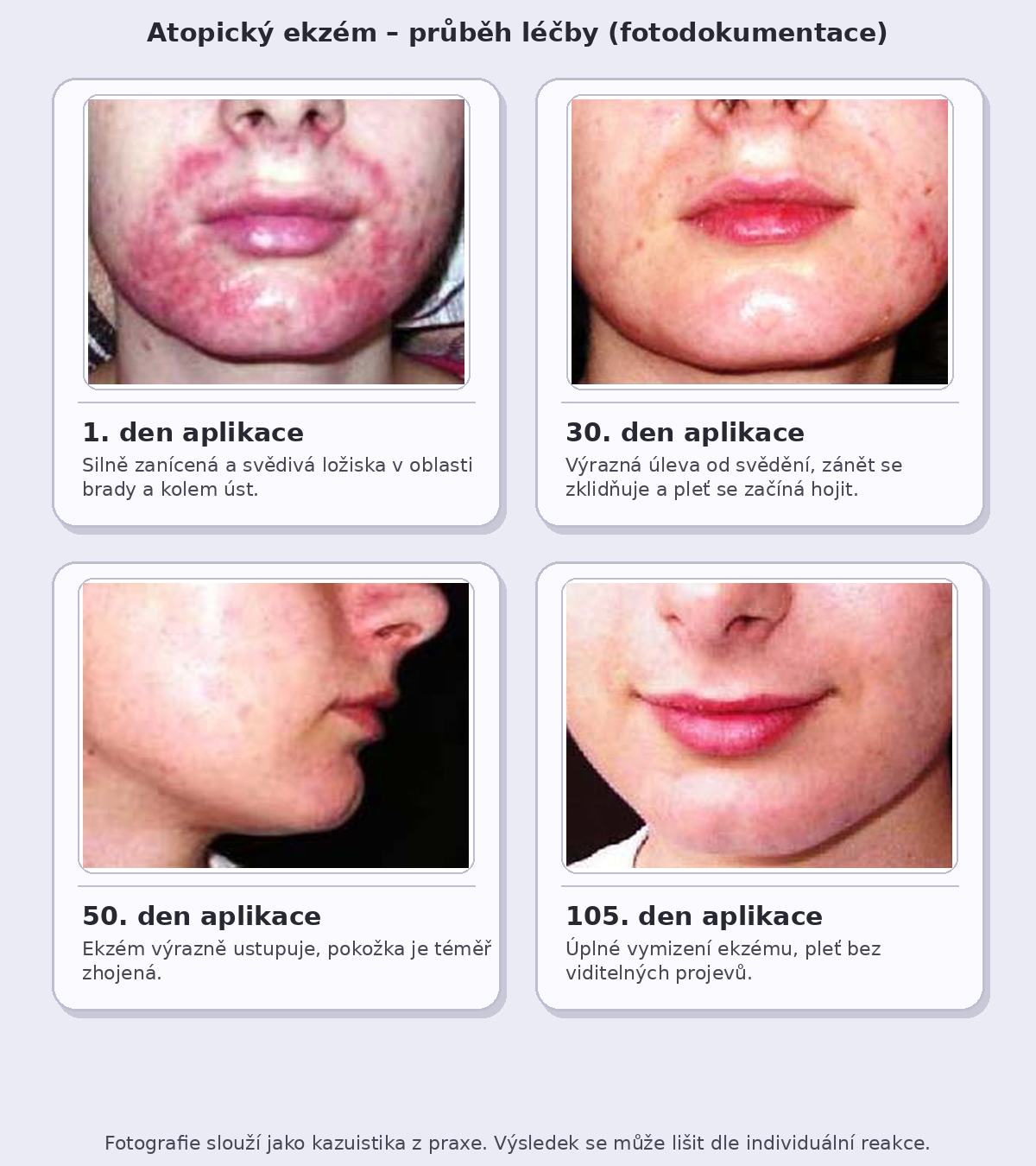 atopicky_ekzem_fotky_s_popisky