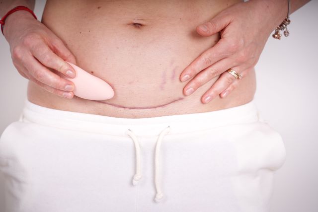 MomCare Masážní přístroj a masáž jizvy ženy po císařském řezu