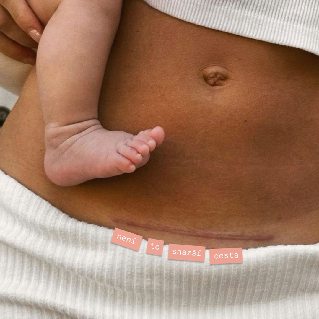 Jak a na co se připravit při plánovaném porodu císařským řezem