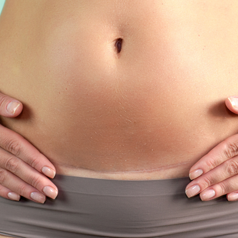 Nejčastější otázky na porod císařským řezem