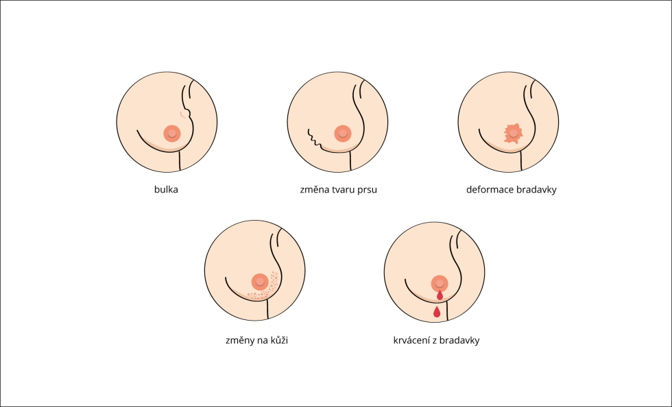 projevy-rakoviny-prsu