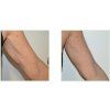 ellisys forearm