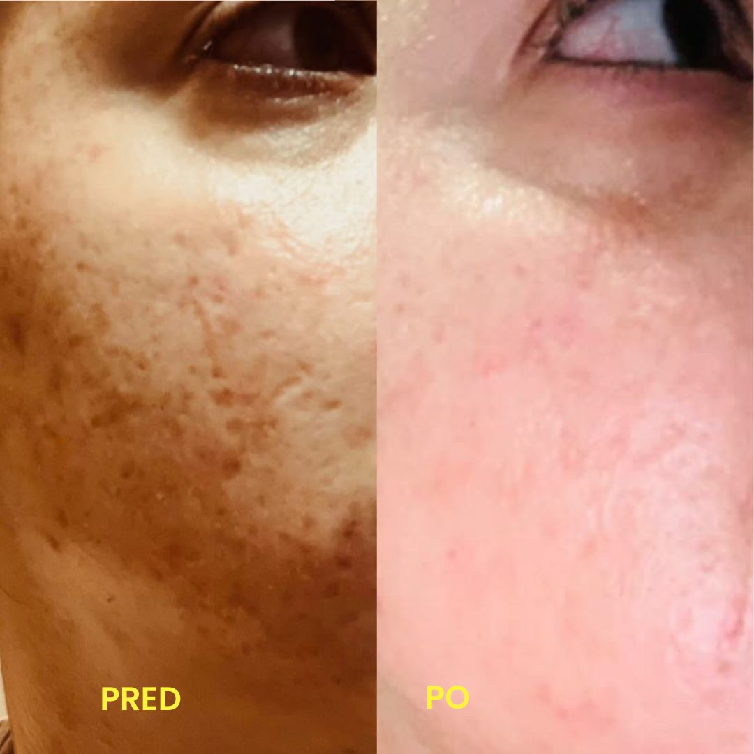 Premena — tvár jazvy