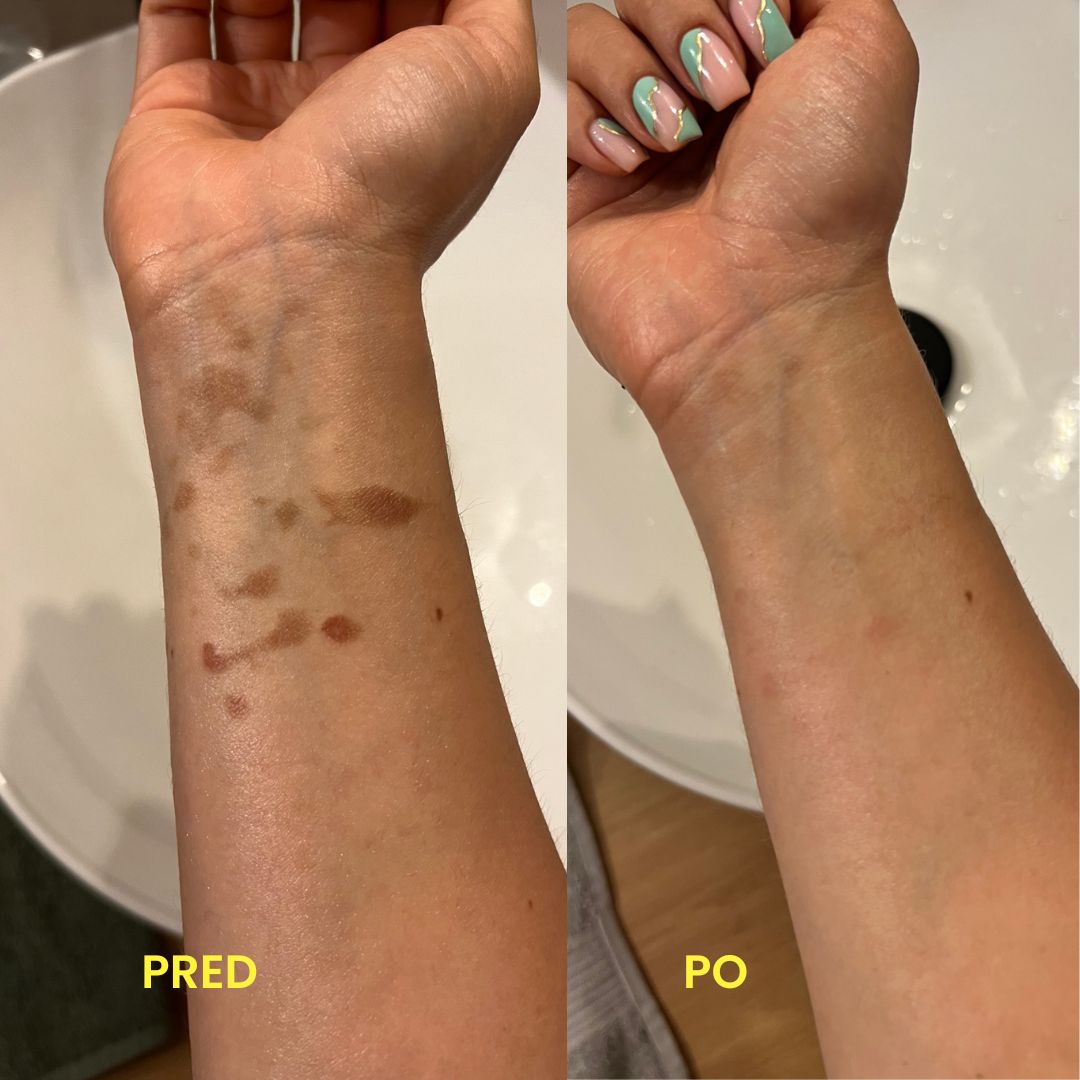 Popálenina — ruka