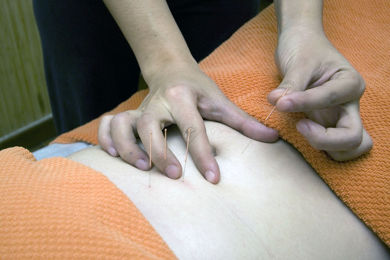 acupuncture-4175625_1280