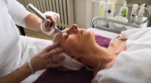 Mezoterapie dermapenem: Účinná a dostupná omlazující procedura