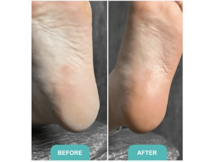 Foot Callus Softening Foam Soft Blade Shelly 150 ml