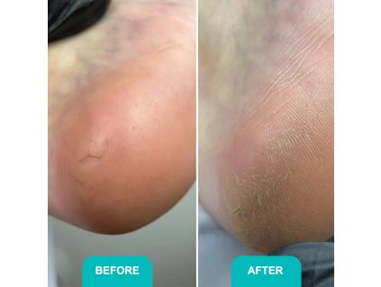 Сallus and corns softening gel Soft blade Shelly 200 ml