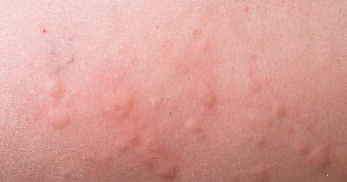 alergicka-vyrazka-koprivka