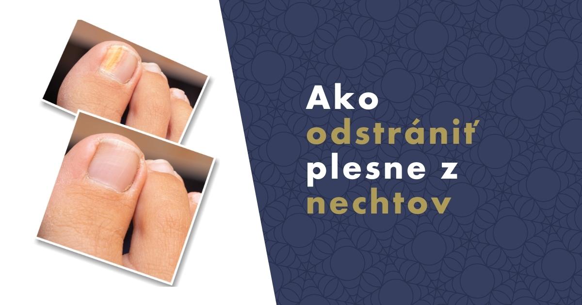 ako-odstranit-plesne-z-nechtov-fb