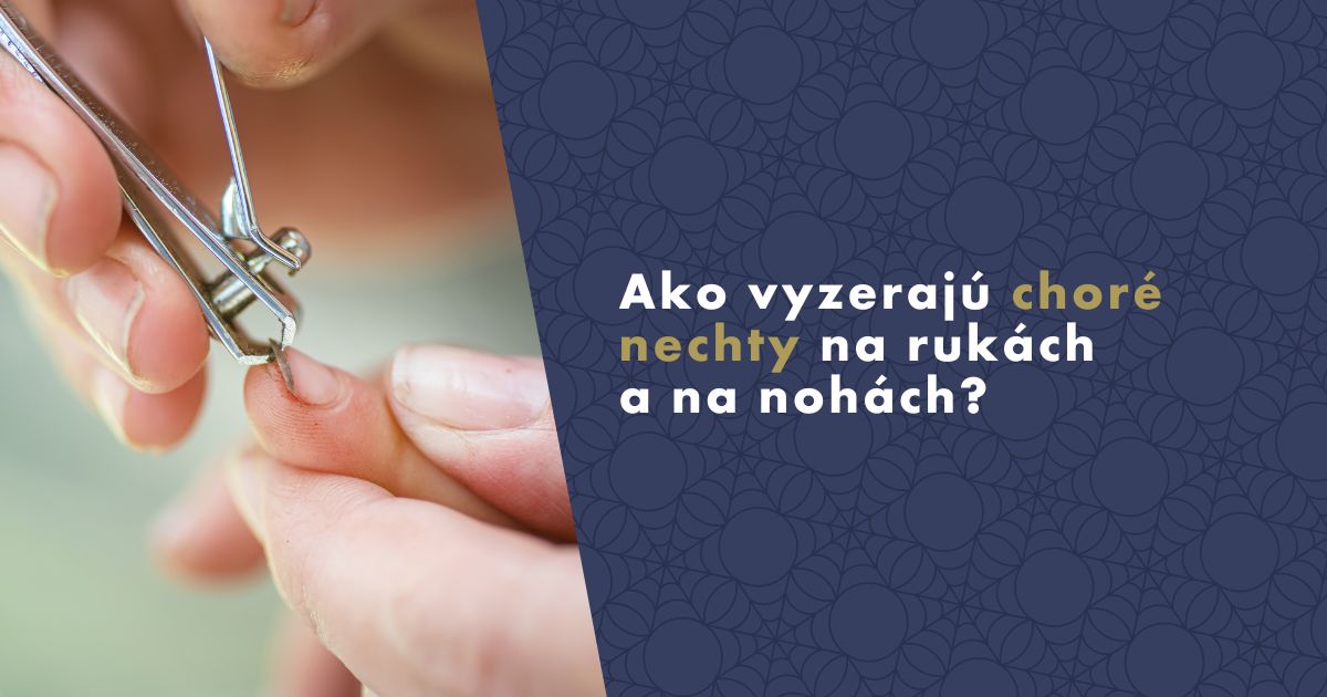 ako-vyzeraju-chori-nechty-fb