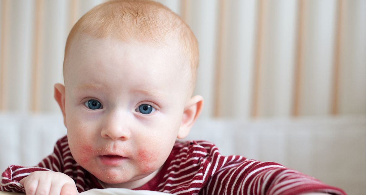 atopicky-ekzem-deti