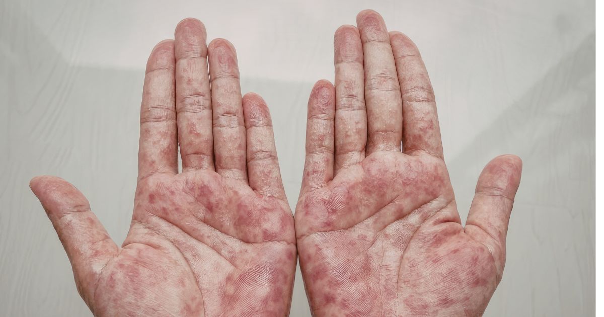 ekzem-ruce