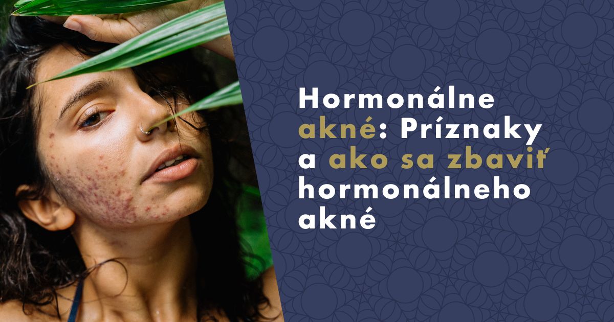 hormonalne-akne-priznaky-ako-se-zbavit-akne-fb