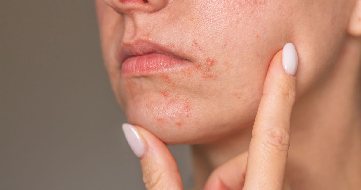 perioralni-dermatitida