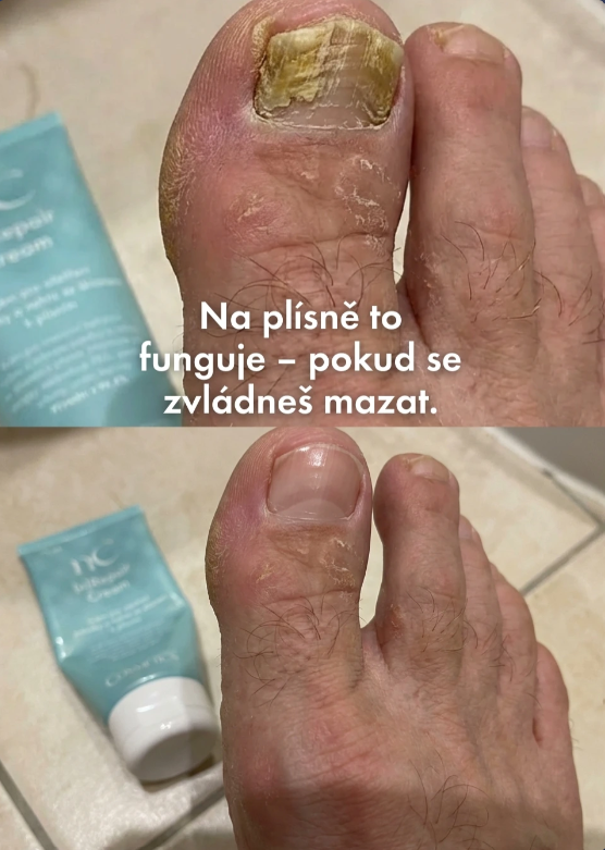 Péče o nehty při plísni