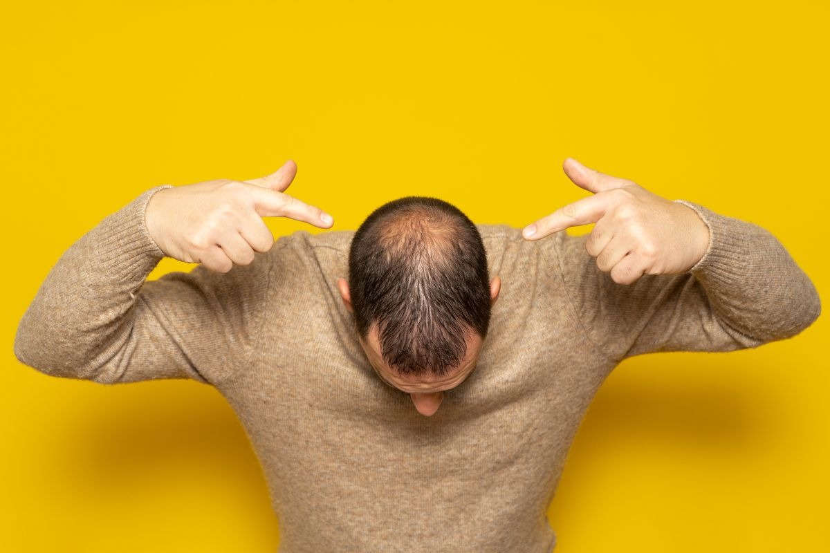 alopezie