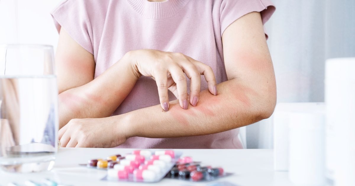 atopische-dermatitis-haut-allergien