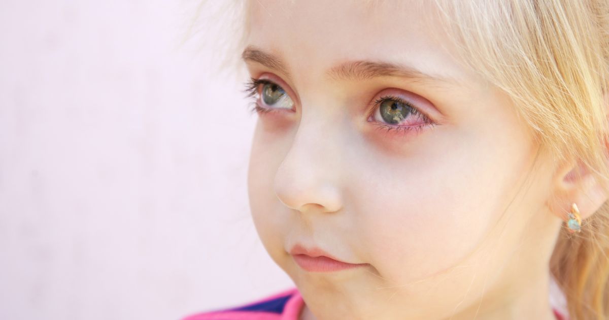 bindehautentzuendung-bei-kindern-ansteckend