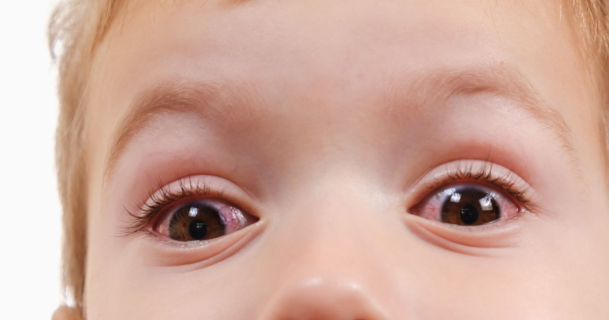 bindehautentzundung-ursachen